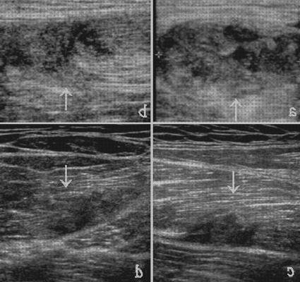Las mejores marcas de aductor aductor largo ecografía