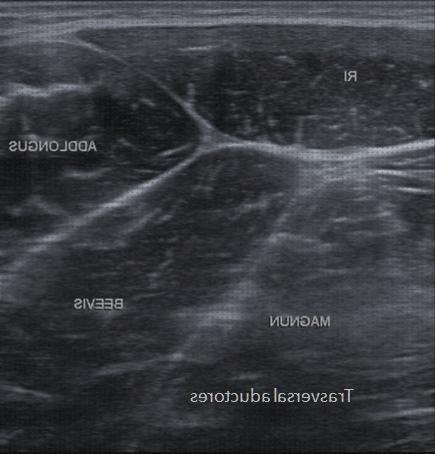 Las mejores aductor aductor largo ecografía