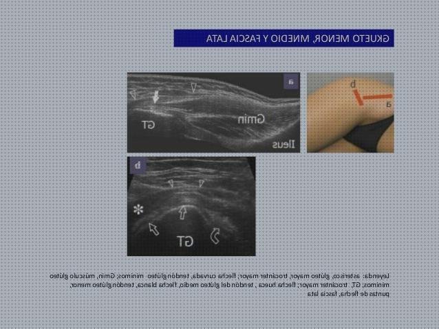 Review de aductor largo ecografía