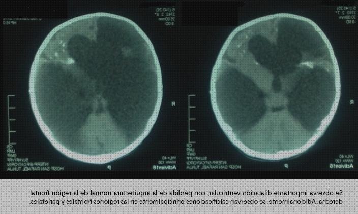 ¿Dónde poder comprar alteraciones electrocardiográficas Mas hipertensión pulmonar primaria espirometría Mas biometria oftalmologia lampara de hendidura alteraciones ecograficas en chagas congenito?