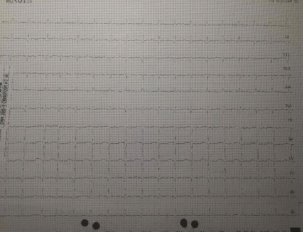 ¿Dónde poder comprar alteraciones electrocardiográficas Mas hipertensión pulmonar primaria espirometría Mas biometria oftalmologia lampara de hendidura alteraciones electrocardiograficas en insuficiencia cardiaca?