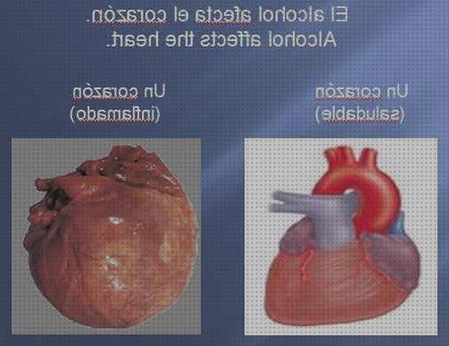 Review de alteraciones electrocardiograficas en insuficiencia cardiaca