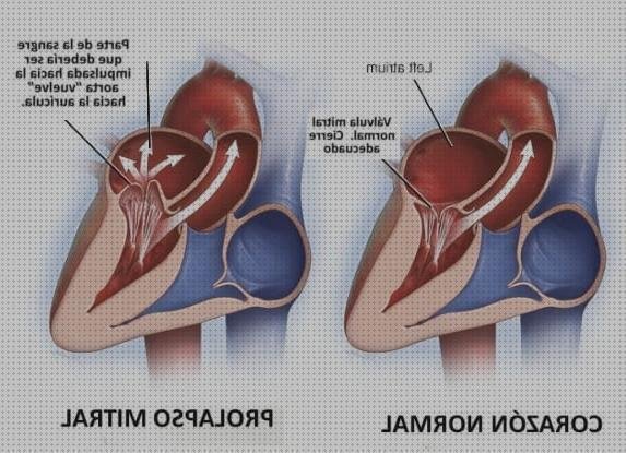 Opiniones de alteraciones electrocardiográficas Mas hipertensión pulmonar primaria espirometría Mas biometria oftalmologia lampara de hendidura alteraciones electrocardiograficas en insuficiencia cardiaca