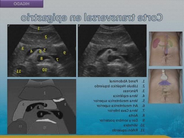 Los 22 Mejores Anatomia Ecografica De Abdómenes