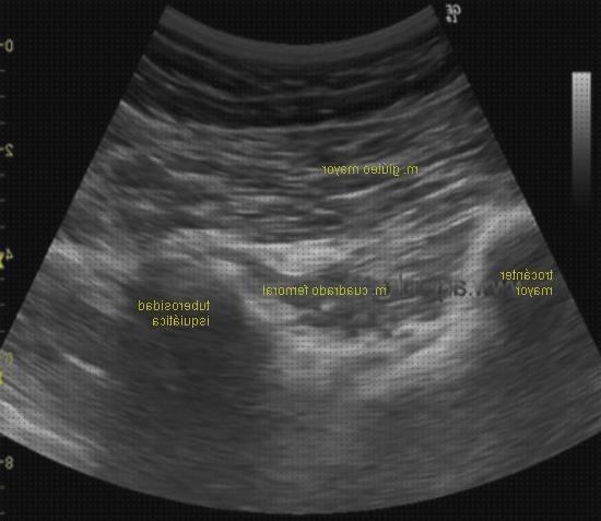 Los mejores 16 Anatomia Ecografica De Gluteos