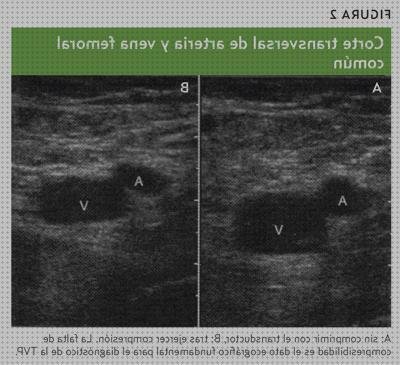 ¿Dónde poder comprar ecografica anatomia ecografica normal del tobillo y pie slideshare?