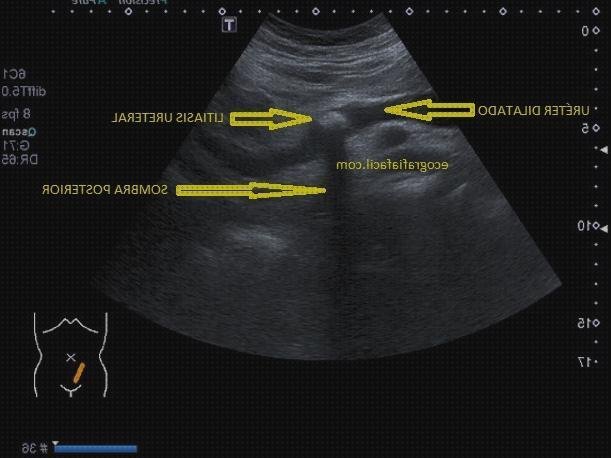 ¿Dónde poder comprar anatomia anatomía ecográfica uréter?