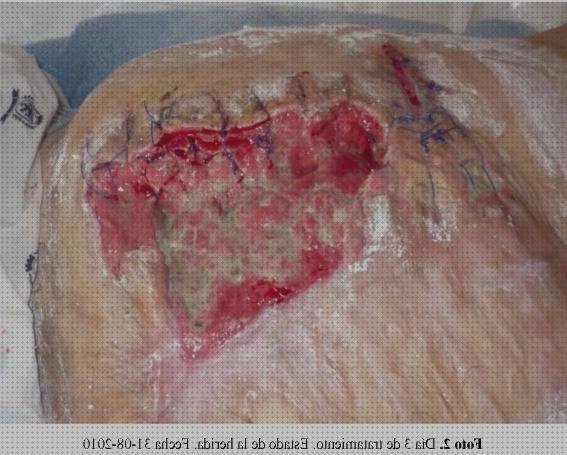 ¿Dónde poder comprar Mas apósito carbono apósito apósito abdomen abierto?