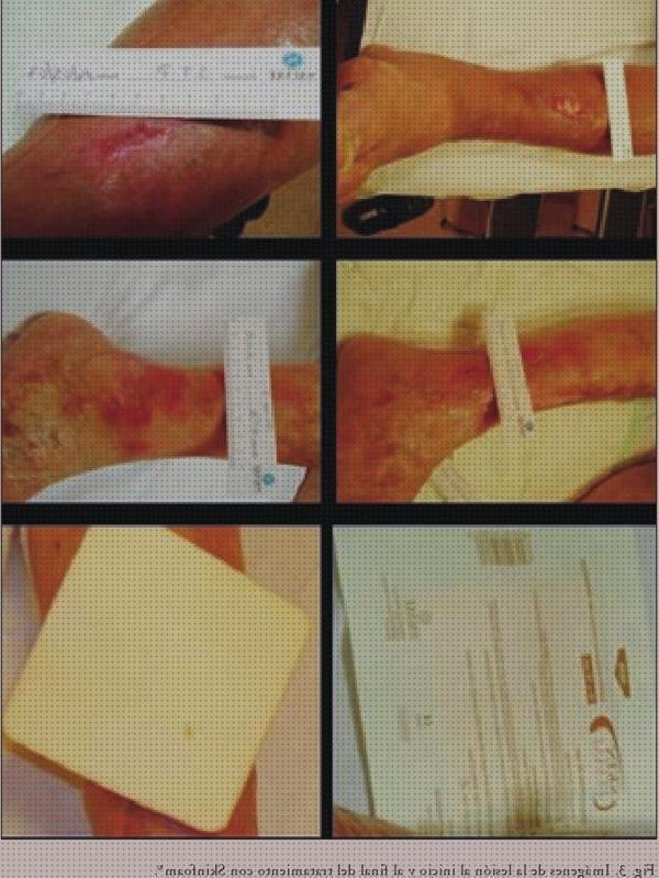 ¿Dónde poder comprar apósitos espuma apósitos apósitos espumas polimericas?