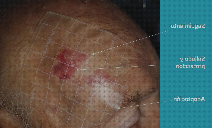 Los 16 Mejores Apósitos Hidrocoloides Heridas