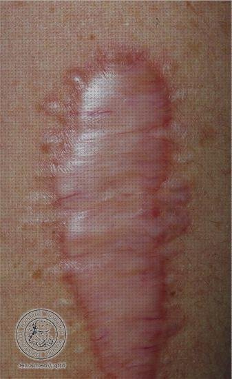 Las mejores marcas de apósitos húmedos apósitos apósitos húmedos ejecutados en gel de silicona