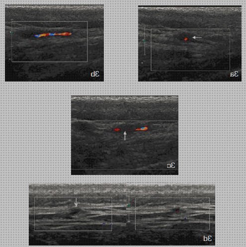 Review de los 18 mejores arteritis médicos para comprar