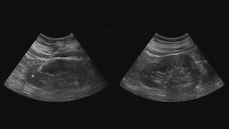 Las 4 Mejores Biopsias Con Agujas Ecografo