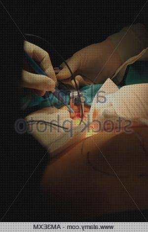 Los mejores 22 Bisturi Electricos Cirugia Abdominañ