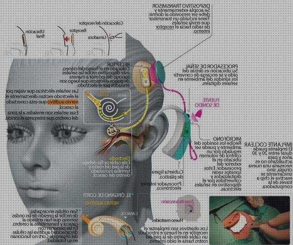 Los 7 Mejores Bisturi Electricos Implantes Coclear