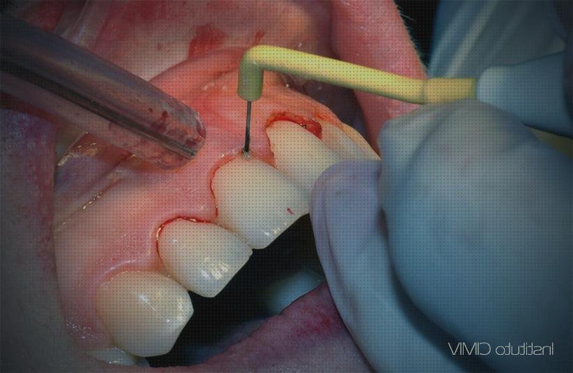Review de bisturi electrico y brackets