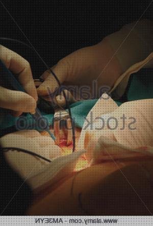 Las mejores marcas de cirugia bisturi bisturi electrico cirugia abdominañ