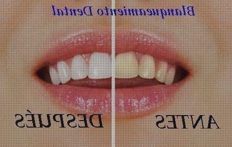 Review de blanqueamiento dental con irrigador dental