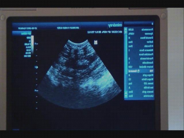 Review de botoneria ecografo mindray