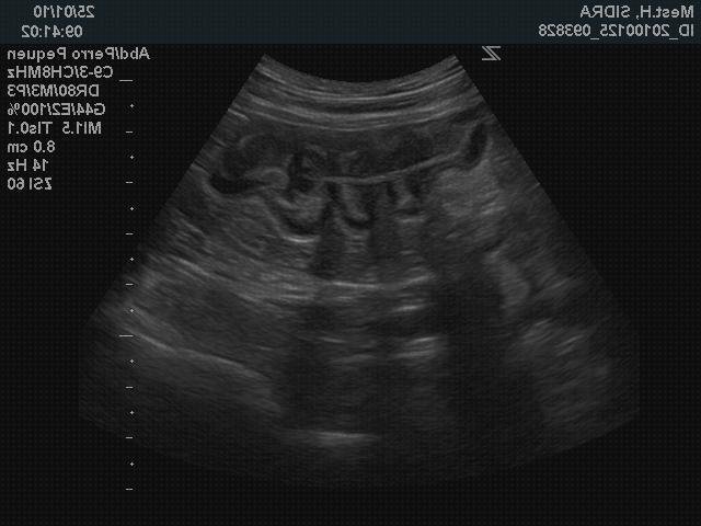 Review de capas ecograficas intestino delgado