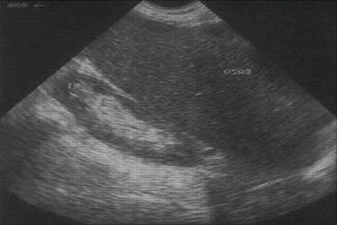 Análisis de las 7 mejores Características Ecográficas Del Bazos