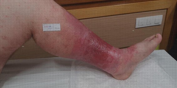 Las mejores 12 Celulitis Infecciosas Y Vendas