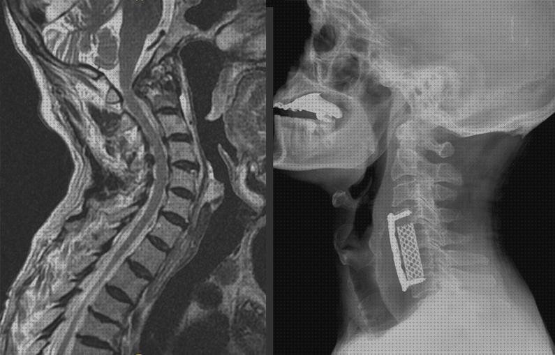 Review de collarin para descomprimir vertebras cervicales