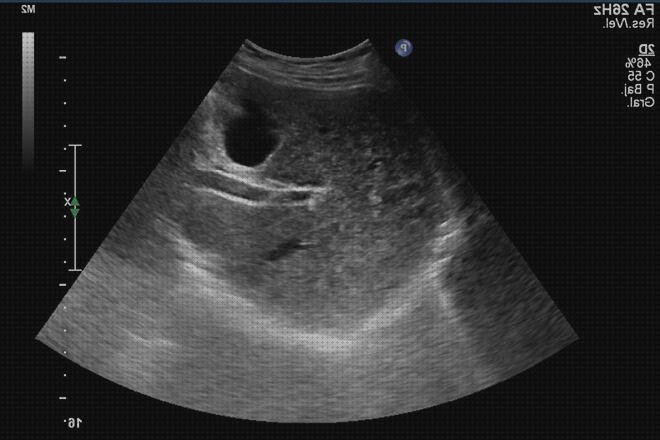 Review de defensas alteradas y ecografía