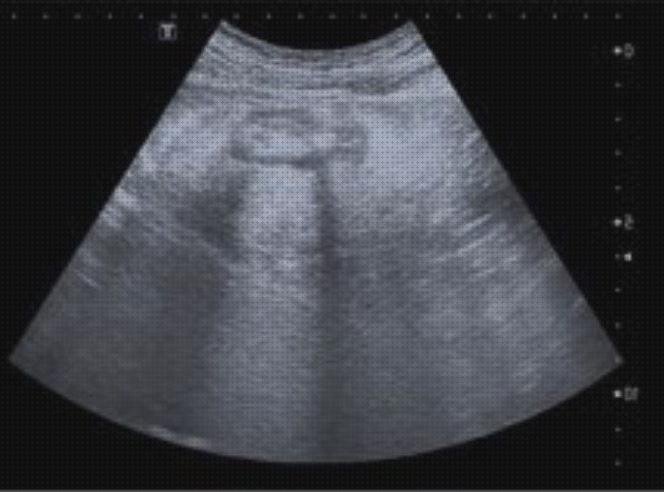 ¿Dónde poder comprar aguda diverticulitis aguda ecografía?