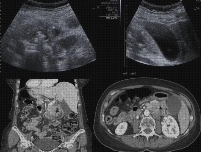 Las mejores aguda diverticulitis aguda ecografía