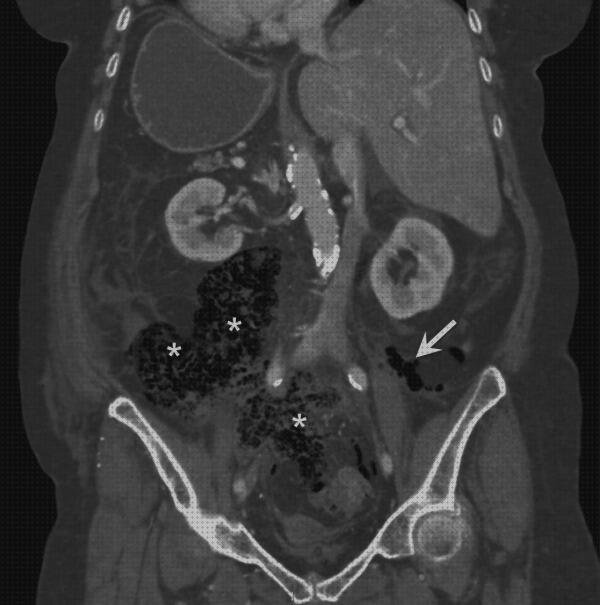 Opiniones de aguda diverticulitis aguda ecografía