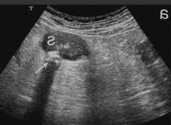 Opiniones de las 6 mejores Diverticulitis Aguda Ecografías