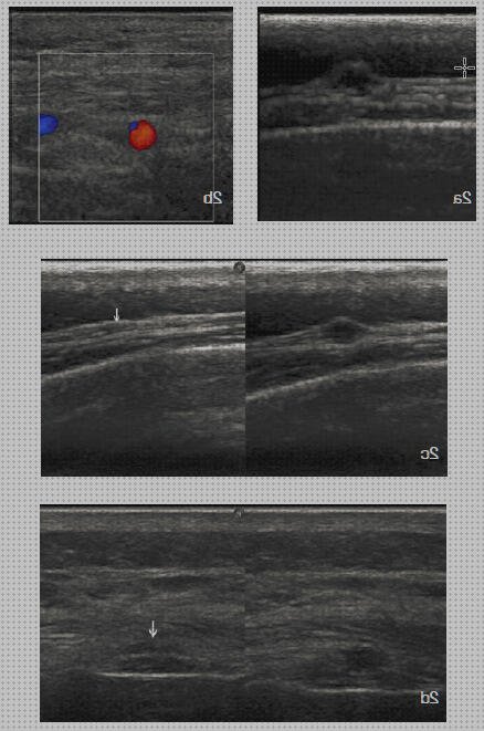 Las mejores arteritis