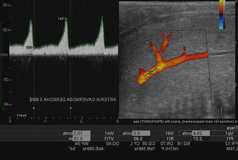 Las mejores marcas de doppler peneana