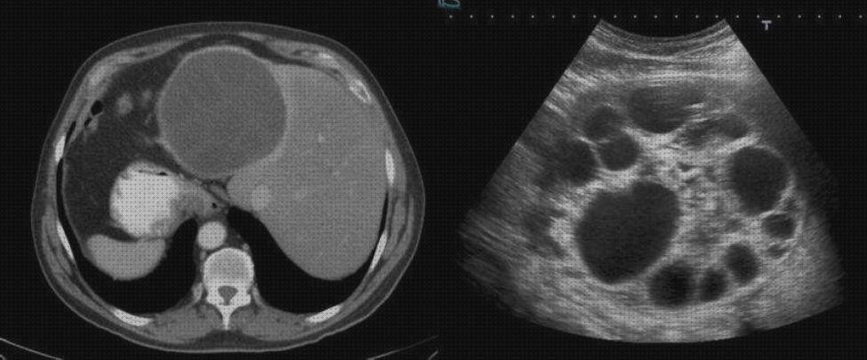 Mejores 0 echinococcus histolytica ecografo