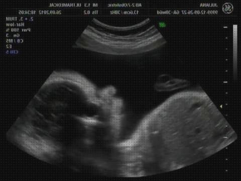 Las mejores marcas de ecografía 12 semanas doppler ecografía doppler eco doppler 34 semanas