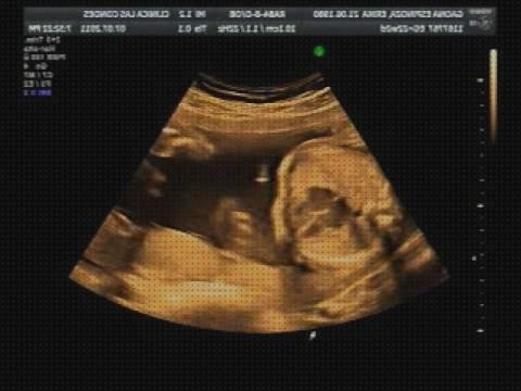 ¿Dónde poder comprar doppler eco doppler 5 meses?