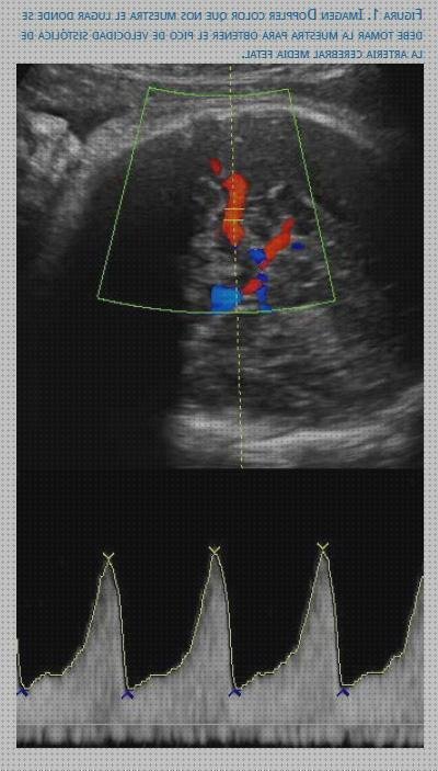 Review de eco doppler anemia fetal