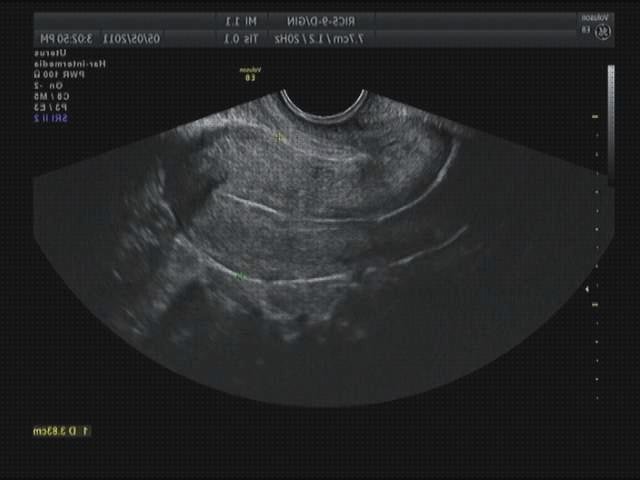 Las mejores marcas de ecografía 12 semanas doppler ecografía doppler eco doppler antes de las 20 semanas