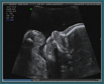 Review de eco doppler antes de las 20 semanas