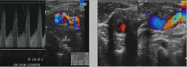 ¿Dónde poder comprar doppler eco doppler ateroma?