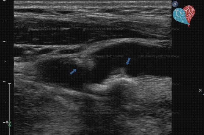 Las mejores doppler eco doppler ateroma