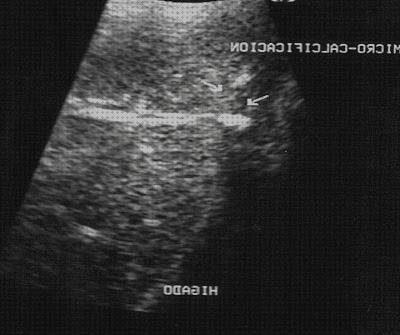 Los 14 Mejores ecos doppler calcificaciones del mundo