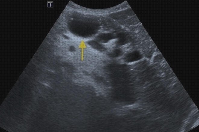 Las mejores marcas de calcificaciones doppler eco doppler calcificaciones