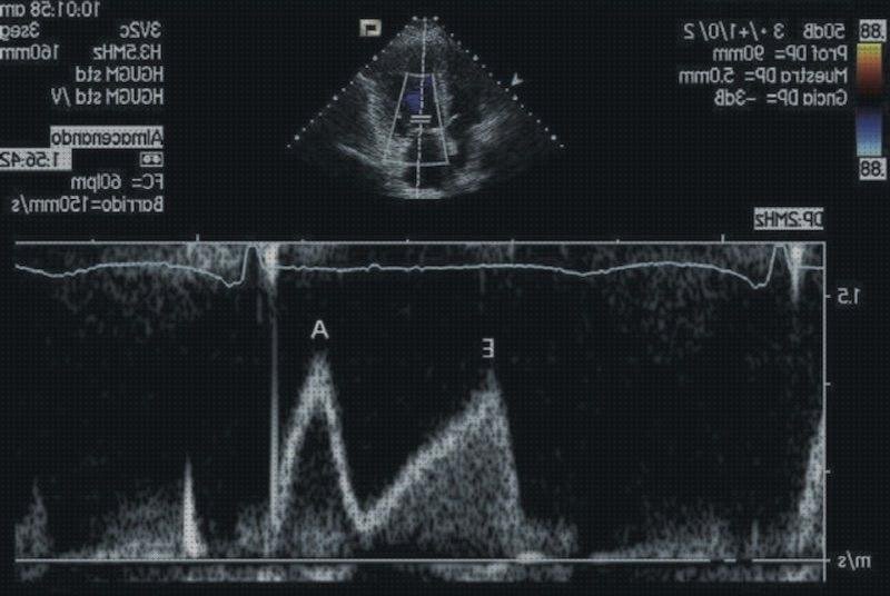 Review de eco doppler cardiaco y ecocardiograma