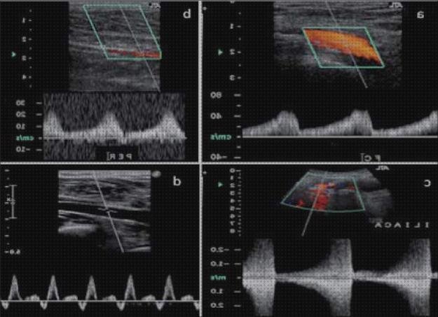 Los 8 Mejores Ecos Doppler Colores Y Pulsados