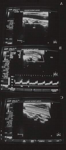 Review de eco doppler color y pulsado