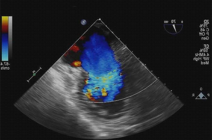 Los mejores 4 Ecos Doppler Cosas E