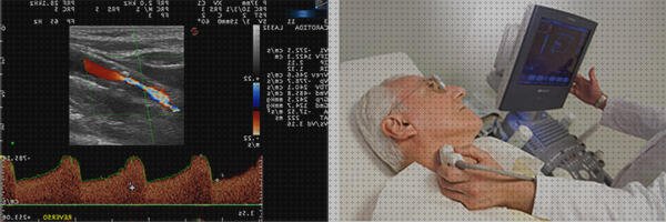 Review de eco doppler de carotidas