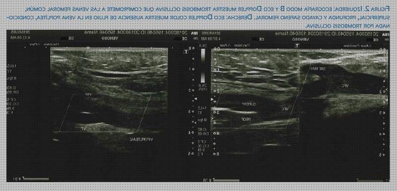 Análisis de los 8 mejores Ecos Doppler De Venas Piernas Izquierdas